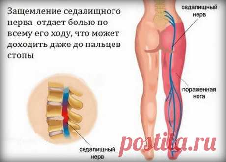 ИШИАС. ЗАЩЕМЛЕНИЕ СЕДАЛИЩНОГО НЕРВА: ЧТО НУЖНО ЗНАТЬ И КАК СПРАВИТЬСЯ С НЕДУГОМ?