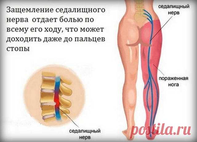 ИШИАС. ЗАЩЕМЛЕНИЕ СЕДАЛИЩНОГО НЕРВА: ЧТО НУЖНО ЗНАТЬ И КАК СПРАВИТЬСЯ С НЕДУГОМ?