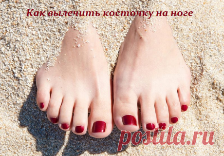 Как вылечить косточку на ноге