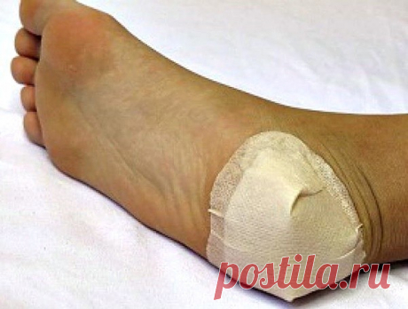 ШПОРУ ВЫЛЕЧИЛА ЗА 3 ДНЯ
 
Поделюсь рецептами от пяточных шпор. Прошлым летом на юге после ванн у меня так разболелась нога, что я не знала, куда ее деть. Пятка горела огнем. Приехав домой, побежала к хирургу. Молодая врач сделала снимок и объявила, что у меня после ванн обострилась пяточная шпора. Дала мне какую-то «памятку» - и все. Я поняла, что надо самой лечиться. Обратилась к народной медицине - стала искать рецепты от шпор. Все, что нашла, выписала и посылаю вам. Вед...