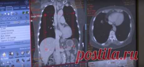 Рак легких: как заподозрить заболевание на ранней стадии