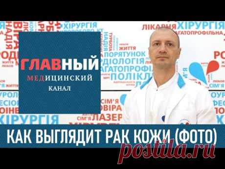 Как выглядит рак кожи (фото 1-8). Меланома, базалиома и плоскоклеточный рак кожи