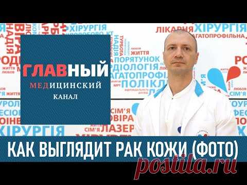 Как выглядит рак кожи (фото 1-8). Меланома, базалиома и плоскоклеточный рак кожи