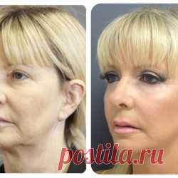 Как решить проблему обвисших щек | Golbis