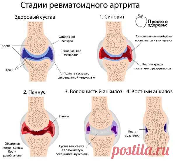 СУПЕРЛЕЧЕНИЕ - КАРТОФЕЛЬ НА КЕФИРЕ ПРОТИВ АРТРИТА