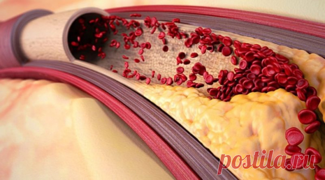 Чистка сосудов: как продлить жизнь? | Info-Health.info