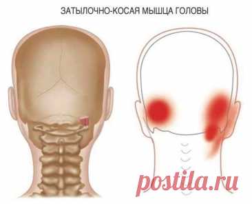 Головная боль в затылке. Триггерные точки