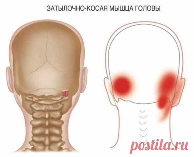 Головная боль в затылке. Триггерные точки