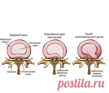 Йога при межпозвоночной грыже