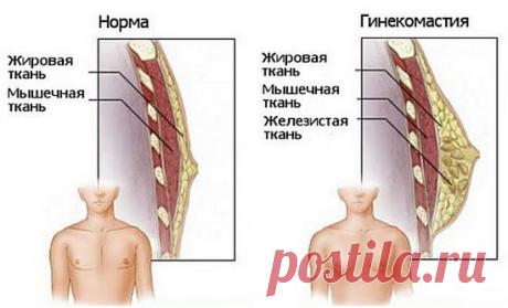 Гинекомастия у мужчин: причины, лечение
Гинекомастия у мужчин, причины возникновения, провоцирующие факторы, медикаментозное лечение гинекомастии, в каких случаях проводят хирургическое вмешательство