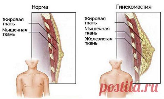 Гинекомастия у мужчин: причины, лечение
Гинекомастия у мужчин, причины возникновения, провоцирующие факторы, медикаментозное лечение гинекомастии, в каких случаях проводят хирургическое вмешательство