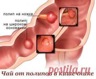 ЧАЙ ОТ ПОЛИПОВ В КИШЕЧНИКЕ. 
В лечении полипов кишечника можно использовать сбор трав, которые обладают необходимыми целительными свойствами. 
Для этого понадобятся: чистотел, трава тысячелистника, цветки календулы. Чистотел и т…