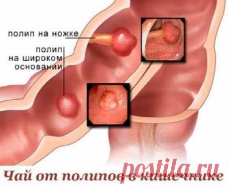 ЧАЙ ОТ ПОЛИПОВ В КИШЕЧНИКЕ. 
В лечении полипов кишечника можно использовать сбор трав, которые обладают необходимыми целительными свойствами. 
Для этого понадобятся: чистотел, трава тысячелистника, цветки календулы. Чистотел и т…