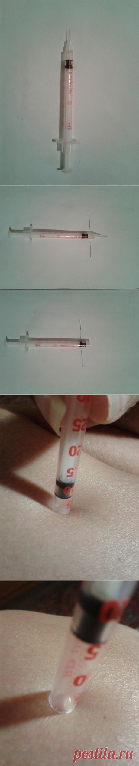 Как извлечь клеща с помощью шприца
