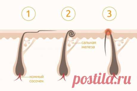 Как избавиться от вросших волос — лучшие советы