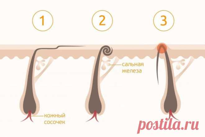 Как избавиться от вросших волос — лучшие советы