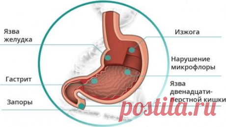 Убираем боль в желудке. Лечение язвы, гастрита
