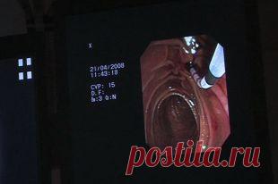 Полипы в кишечнике. Как не пропустить первые симптомы