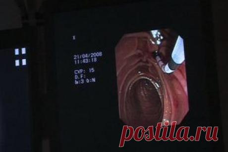 Полипы в кишечнике. Как не пропустить первые симптомы | Полезные инструкции от aif.ru