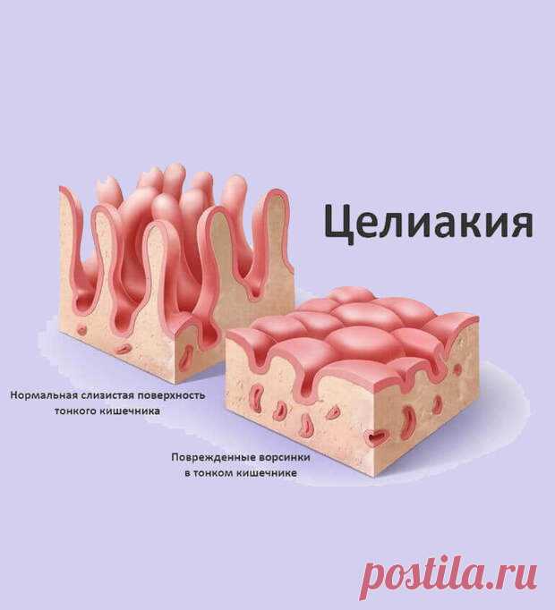 Что такое Целиакия
Целиакия не только может вызывать тревожные симптомы, которые могут ухудшить качество жизни, но также несет в себе риск некоторых потенциально серьезных осложнений, если её не лечить.          Целиакия является наследственным заболеванием, которому в первую очередь подвержены представители Северной Европы, но все чаще оно регистрируется и в других странах. По имеющимся данным, до 1% населения страдает […]
Читай пост далее на сайте. Жми ⏫ссылку выше