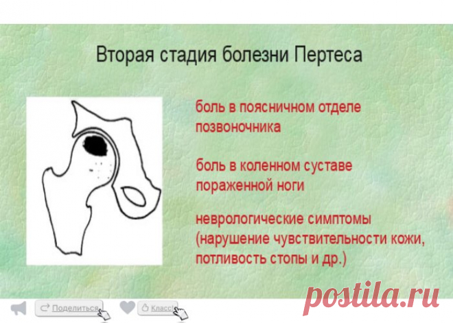 Асептический некроз головки бедренной кости (инфаркт тазобедренного сустава)