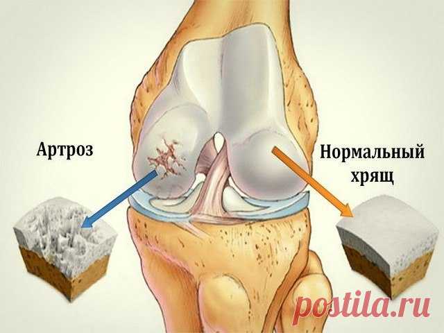 ДОМАШНИЙ НАПИТОК, КОТОРЫЙ ПОМОЖЕТ СУСТАВАМ