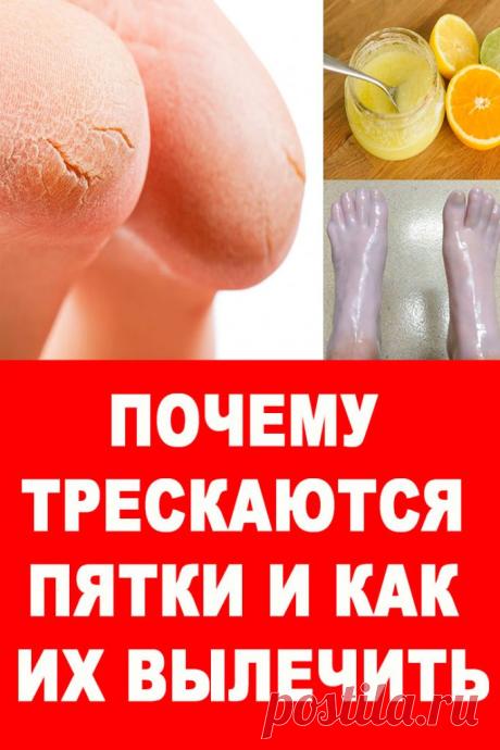 ПОЧЕМУ ТРЕСКАЮТСЯ ПЯТКИ И КАК ИХ ВЫЛЕЧИТЬ — Женские Советы