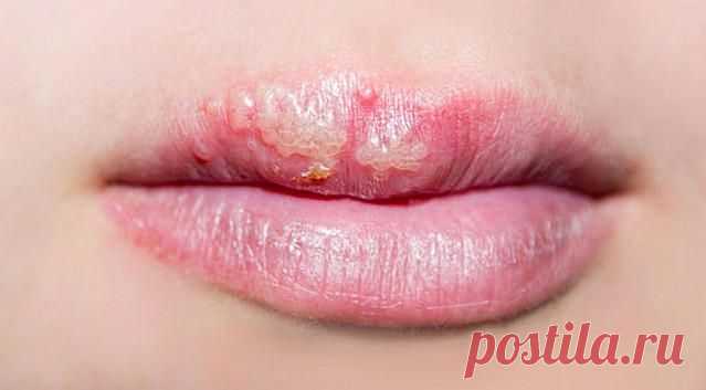 Герпес на губах: основные причины болезни, симптомы и ее лечение