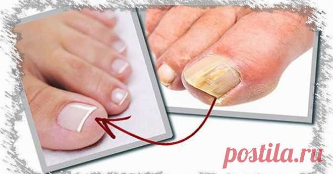 Лучший и самый экономичный способ устранения грибка ногтя и только с 1 ингредиентом! Подробнее в видео! Лечение грибка ногтей в домашних условиях, безопасно, эффективно, народными методами, 100% результат! Грибок ногтей — это действительно частая проблема для многих. Большинство лекарств, купленных в аптеках, неэффективны и имеют побочные эффекты. Грибок ногтя происходит из-за грибковой инфекции, вызванной использованием закрытых ботинок и влаги. Ногти начинают желтеть, и ...