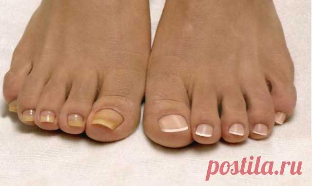 Лучшее домашнее средство от грибка ногтей, всего из 2 ингредиентов Пожелтение и отслаивание ногтевой пластины, появление трещинок и зуд между пальцами — симптомы грибковой инфекции. Статистика свидетельствует, что каждый 5-й житель Земли страдает от этой проблемы.
Сн…