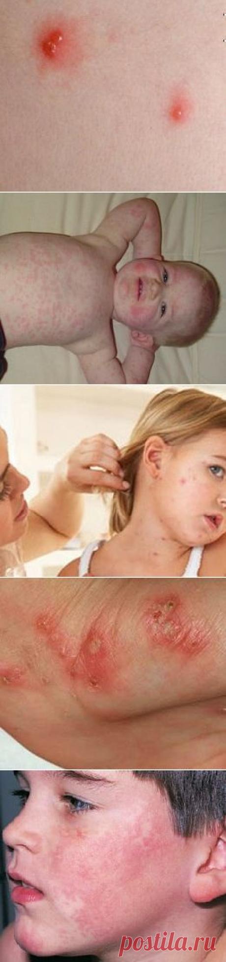 Сыпь у ребенка - причины и лечение - Сосед-Домосед