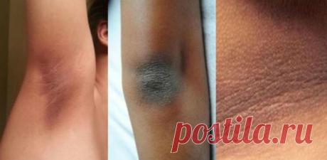 Вот полное руководство, чтобы удалить темную кожу от шеи, локтей, коленей и подмышек