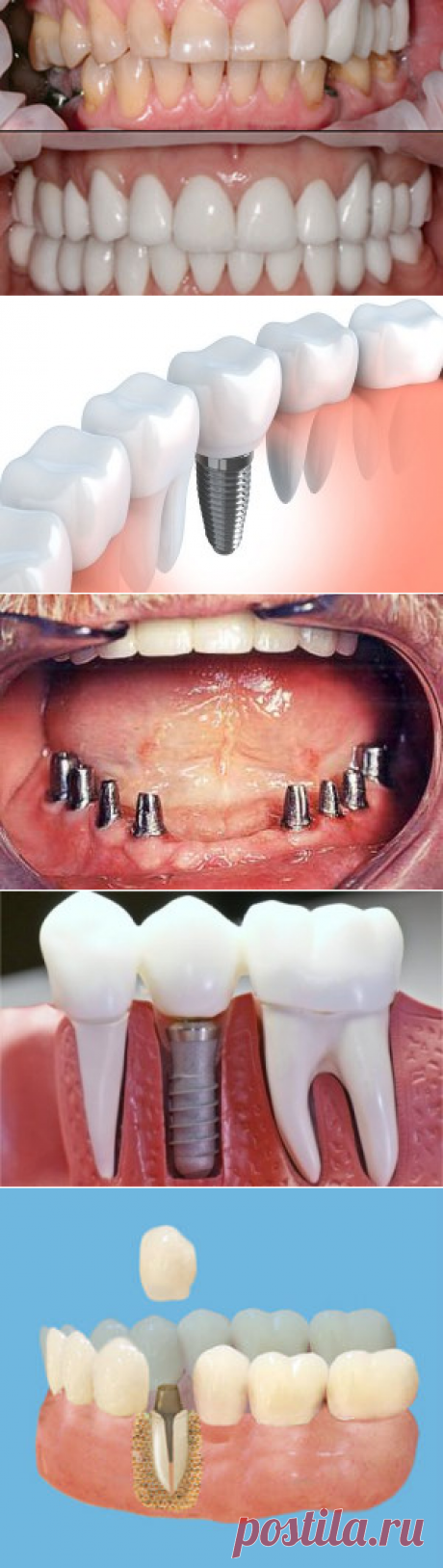 Ортопедия зубов в стоматологии Химки недорогие цены | MEDIVEL