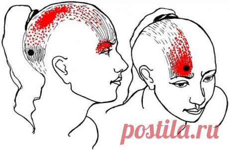 Головная боль в области лба. Триггерные точки