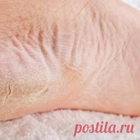 Ороговевшая кожа ног? Это средство лучше пемзы и даже электрической пилки!