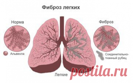 Осложнение после Covid-19: фиброз легких