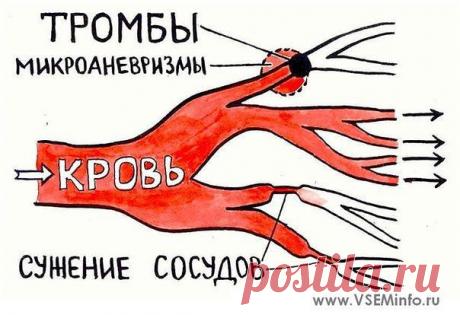 ПРОФИЛАКТИКА ОБРАЗОВАНИЯ ТРОМБОВ. | Блог сайта Muza.Name