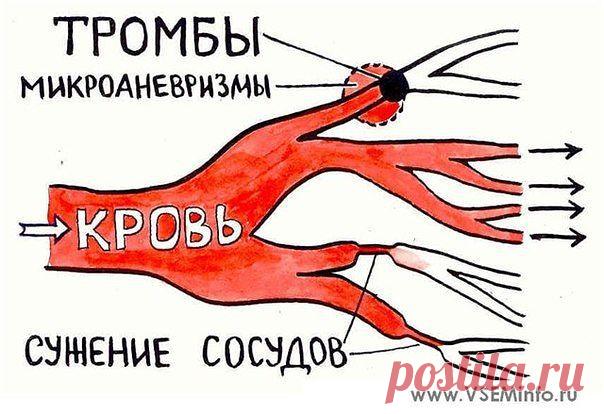 ПРОФИЛАКТИКА ОБРАЗОВАНИЯ ТРОМБОВ. | Блог сайта Muza.Name