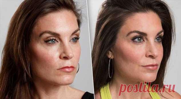Долой скорбную мину: как с помощью косметологов убрать гримасу недовольства . Милая Я