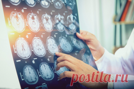 Рискуют все. Врач рассказала о главных причинах инсульта. Если выявлен атеросклероз — значит, инсульт неизбежен?