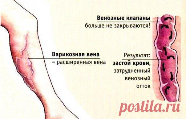 Будем здоровы!
ПОДРОБНО О ВАРИКОЗНОМ РАСШИРЕНИИ ВЕН