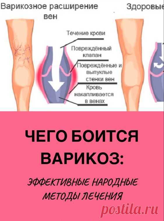 8 рецептов лечения варикоза народными средствами
Предлагаем вам самые действенные рецепты лечения варикозного расширения вен народными средствами.