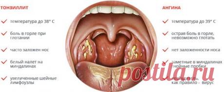 Хронический тонзиллит: симптомы, лечение в домашних условиях и традиционное