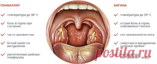 Хронический тонзиллит: симптомы, лечение в домашних условиях и традиционное