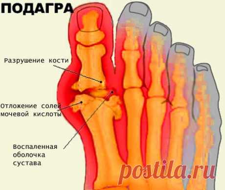Подагра - симптомы и лечение, диета при подагре