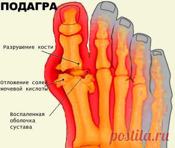 Подагра - симптомы и лечение, диета при подагре