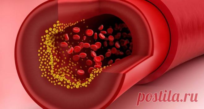 Почему низкий уровень холестерина грозит кровоизлиянием в мозг / Будьте здоровы