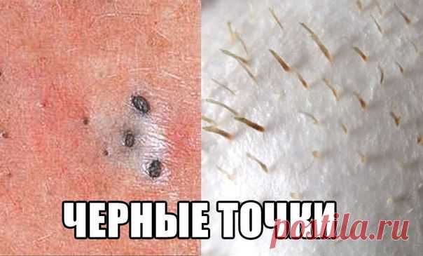 Энциклопедия мудрой хозяйки | VK
Простой и очень дешевый метод удаления себума, грязи и прочих бяк из пор.