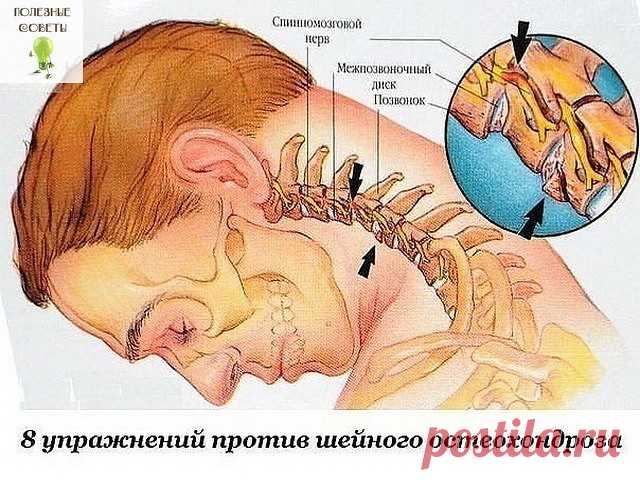 ПОЛЕЗНЫЕ СОВЕТЫ : 
Сохраните, чтобы не потерять.

СОВЕТ 1 : Восемь упражнений против шейного остеохондроза

Первые проявления шейного остеохондроза — боли в спине, головные боли, головокружение, 