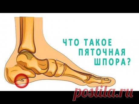 Что такое пяточная шпора и как она лечится?